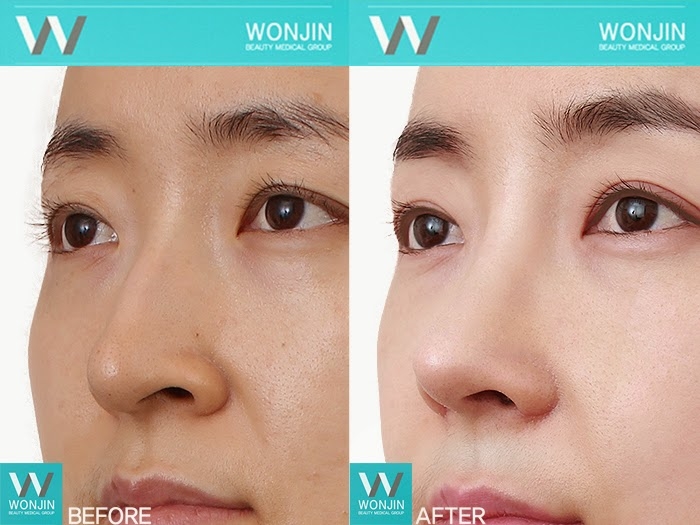 revision rhinoplasty expert los angeles