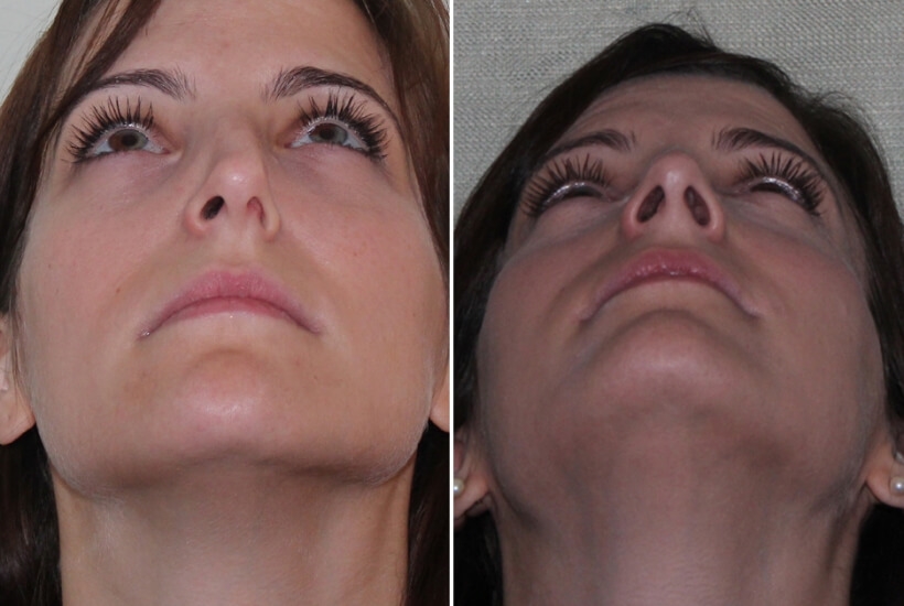 revision rhinoplasty expert los angeles