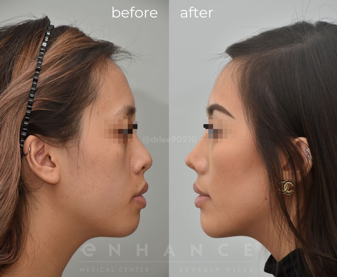 revision rhinoplasty expert los angeles