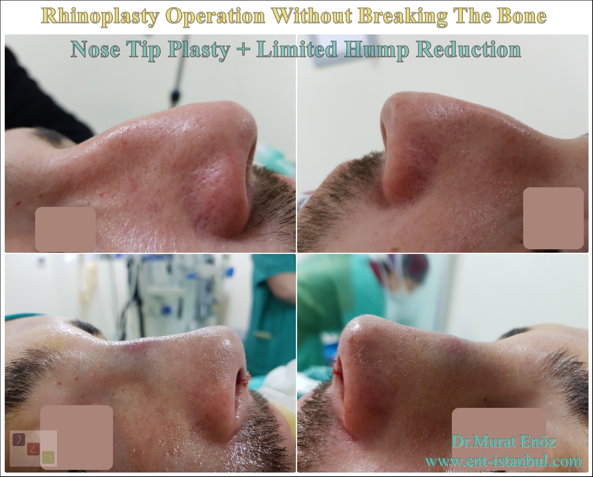 revision rhinoplasty expert los angeles